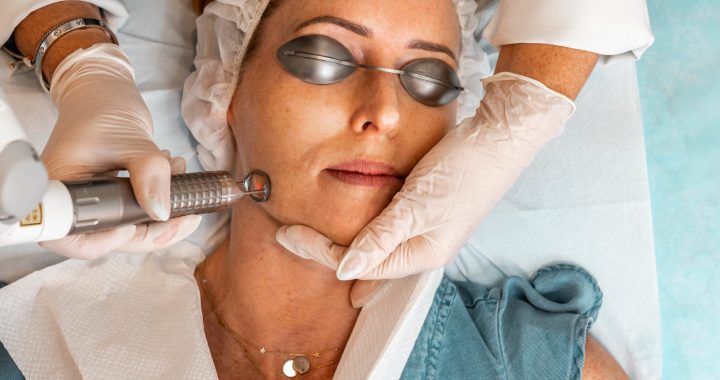 Laser Treatment For Acne - Things You Need To Know