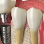 5 Reasons To Choose Same-Day Dental Implants