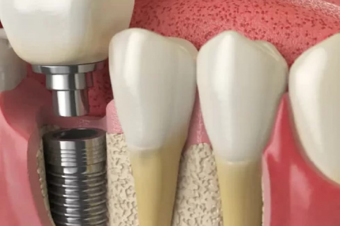 5 Reasons To Choose Same-Day Dental Implants