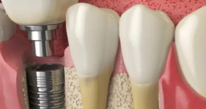 5 Reasons To Choose Same-Day Dental Implants