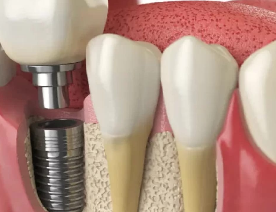 5 Reasons To Choose Same-Day Dental Implants